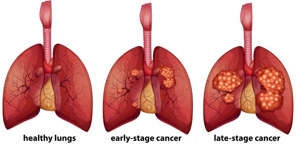 Top Lung Cancer Doctor in Mumbai